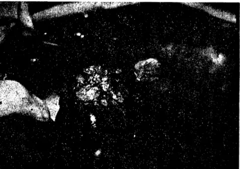 Fig. 8: The stump of the lcft central lobe alter complete excision. Fig. 8: T&#34;,m eksizyondan sonra merkezi lobun kalıntısı.