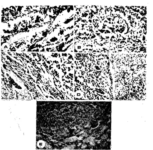Şekil 4. Tümörün mikroskobik görünümü. (The microscopical appearcnce of malignant mclanoma).
