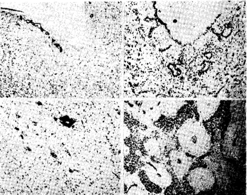 Fig. 14. Partial absence of the ependymal layer in the 3 rd ventridc and sııbependyma! rosettes