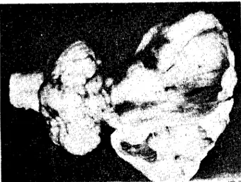 Fig. 4. Hydl'anencephalic brain, slight cerebcllar hypoplasia, and band-shaped n,sidual nerye tissue