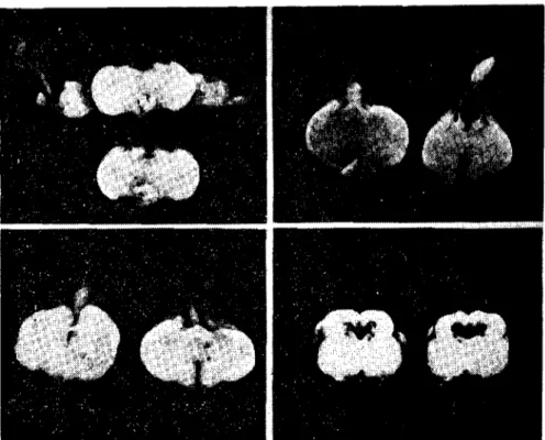 Fig. 6. Displacement of theııineal body. Case no 20, 16.