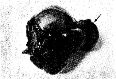 Şekil 2. Pheochromocy'oma'nın kesit yüzü. Üstteki küçük kitle (ok) vena ca va caudalis içindeki tümöral trombüs kesiti