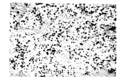 Şekil 3. Vasküler stroma ile çevrelenmiş çok sayıda küçük tümör hücre lobulusları. H.Fx225 (Numerous smail tumor cell lobules surrounded by va,cular stroOla)