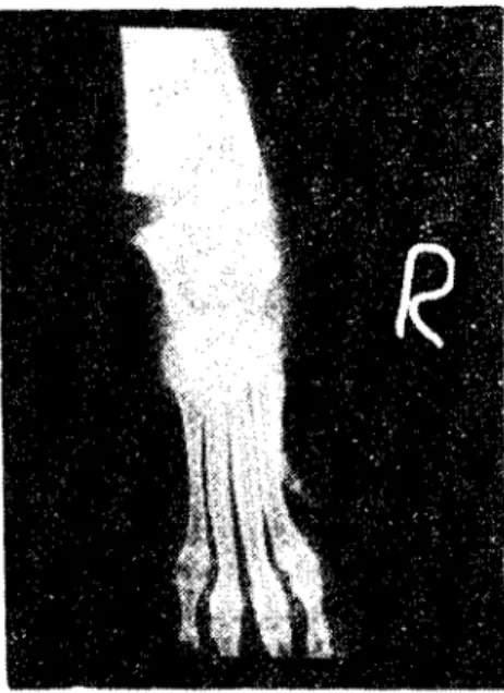 Figure 4. Radiographic vie&#34;'&#34;of the right carpal joint af ter osteolomy and osteosynthese &#34;anterior-posterior position&#34;