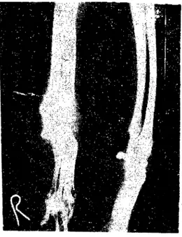 Figure 8. Radiographic view of the carpal joints af ter stapling the right radius &#34;anterior-posterior position&#34;