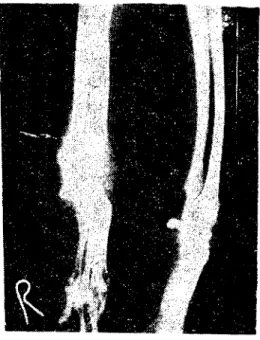 Figure 8. Radiographic view of the carpal joints af ter stapling the right radius "anterior-posterior position"