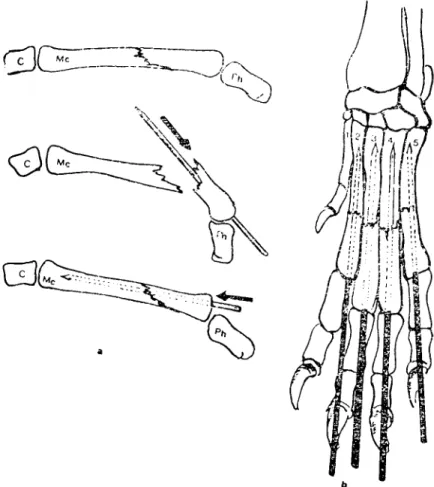 Figure 1. a) Replacement of the intramedullar pin ın the transarticular Mc fracture, b) Schematic reprcsentation of the fixation of ,all the Mc bones in the totally fractured