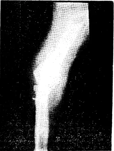 Şekil 4. Olgunıuzun operasyon sonrası radyografisi ..anterior-posterior pozisyon&#34; Posl-operaıive radiography .'anterior-poslerior posiıion&#34;