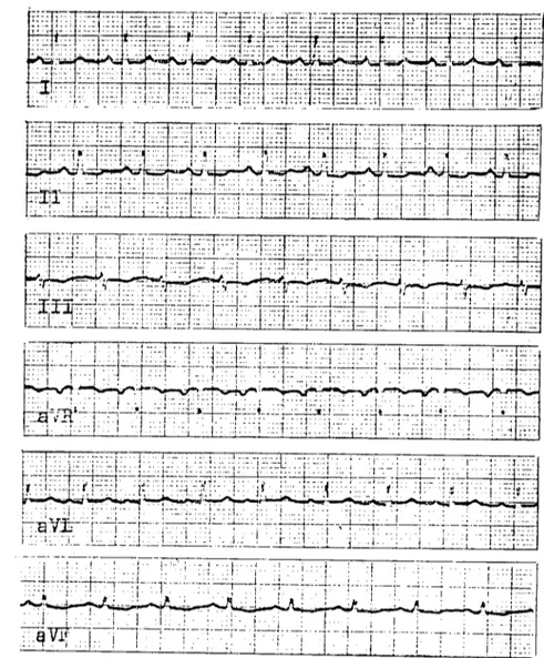 Şekil J. Kobayda normal clcktrokardiyogram. Figure I. Electrocardiogramme normal chez le cobaye.