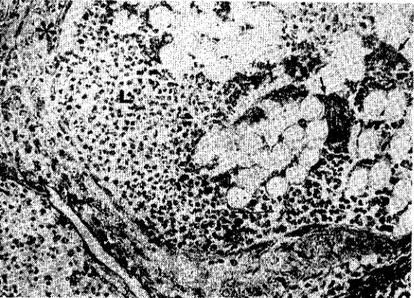 Fig. 10. Three monthly, L) leucocytes; n.sterisks) Fibrous capsule; arrows) Foriegn body giant ceııs X 252.