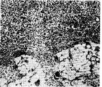 Fig. 5. One monthly, asterisks) Fibrous capsule; arrows) Foreign body giant cells X ı 60.