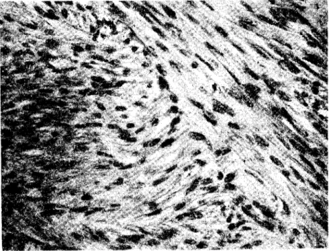 Şekil 3 Ovaryumdaki Iciomyom'un histolojik görünümü. H.E. x 165 (Histological appearance of ovarian leiomyoma)