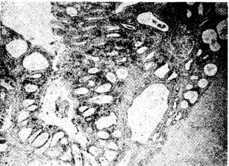 Şekil 4 Endometrium l&gt;ölgesindeki hiperplazi ve kistik bezlerin görünümü. H.E. x 65
