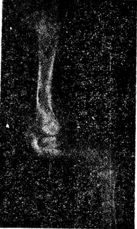 Figure 4. Radiograph of the right antebrachium of female kid; radius was mıssıng except for the proximal epiphysis (about ı cm Jang), ulna rotatect medially