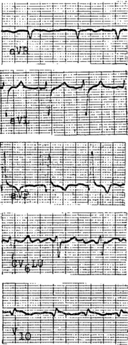 Fig. 4. The electrocardiogram patterns taken from dog 011 the l5.day of strophanektan