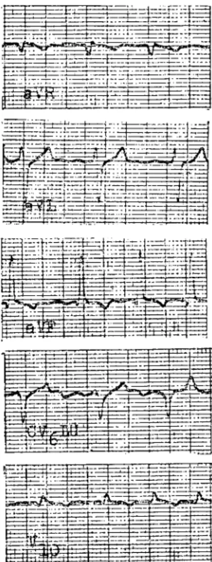 Fig. 2. Electrocardiogram patterns taken from dog before strophanektan and lasix treatment.