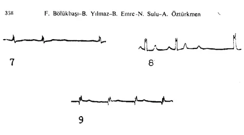 Şekil i. ikinci derece atIİo-venlrikü!c1 hlok, QRS kompleksinde değişim, P-Q ve Q-1'