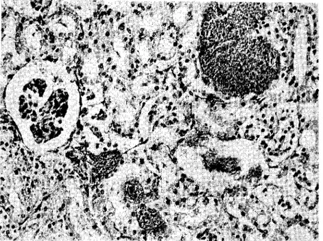 Şekil 4. Böbrekte intcrtubuler kapillarıarı tıkamış bakteri kolonileri. HxE x225 (Bacterial colonization in the intertubular capillaries of the kidney)
