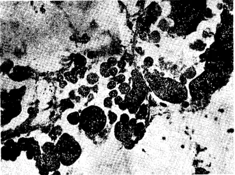 Fig. 7. Sporocysts and rediae invading the acİni of the ovatestis (x 200). (Ovatestis foliklillerinde sporokist ve rediler)
