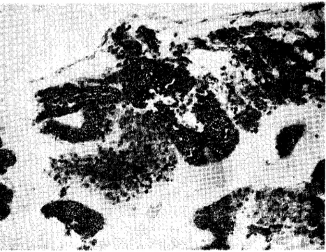 Fig. 5. A) Rep!acement of the digestive gland tubulP.s by the parasite (x 200). (Sindirim b::zi tüplerinin yerini alan parazitler).