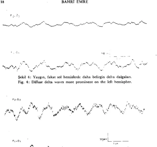 Fig. 4: Diffuse delta wavcs more prominent on the left hemispher.