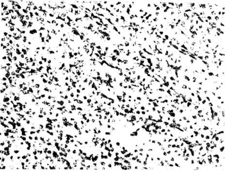 Şekil 3 Tümör hücreleri ile dolu tubuluslar. H.E. X 1000 (The tubules filled with tumor eclIs)