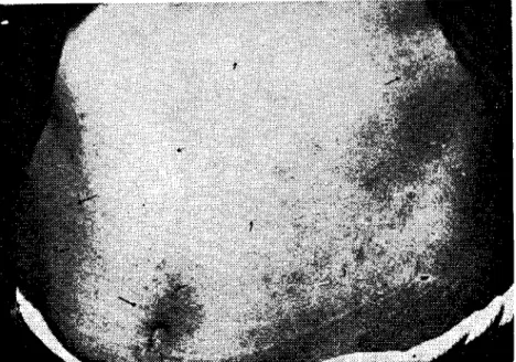Fig. 3. Ski n lesions eaused by C. blakei on calowner.