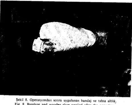 Şekil 8. Operasyondan sonra uygulanan bandaj ve tahta altlık; Fig. 8. Bandage and wooden shoe applied after the operation.