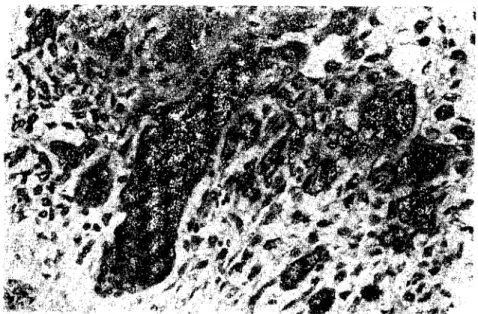 Şekil 3. Çok çekirdekli bir dev hücresi. H.E. X 900 (A ınullinucleated giant ccl1)