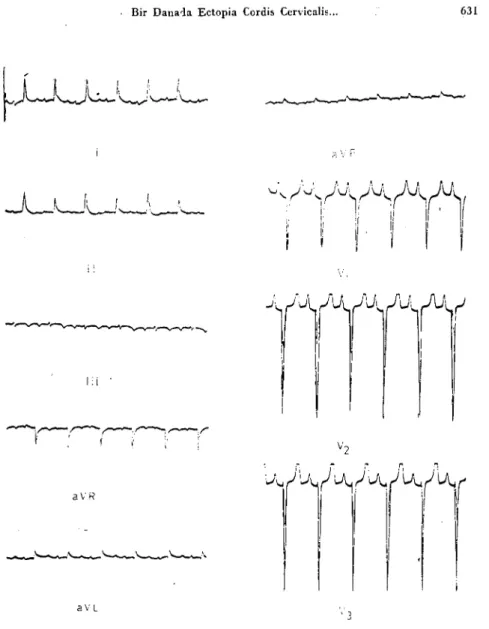 Şekil g. Ectobia Cordis Cervicalis'li2ogiinlük Montafon-Holstein melezi dişi danada elek trokardi yogramörnek ler;.