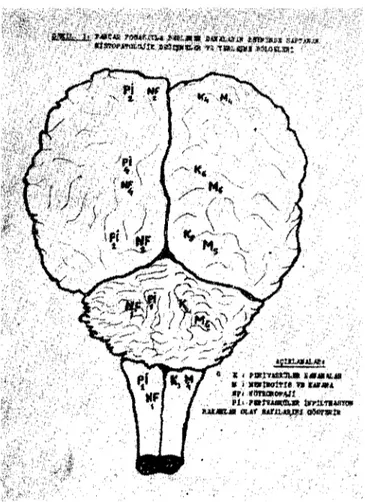 Şekil i : Kuru pancar posasıyla beslenen danaların merkezi sinir sisteminde oluşan perivas- perivas-küler kanama (Kı, meningitis (MJ, neuronophagie (NF) ve perivasküler mononüklear hücre infiltrasyonlannın (Pt) 6 olayda görülüş sıklığı ile yerleşme bölgele