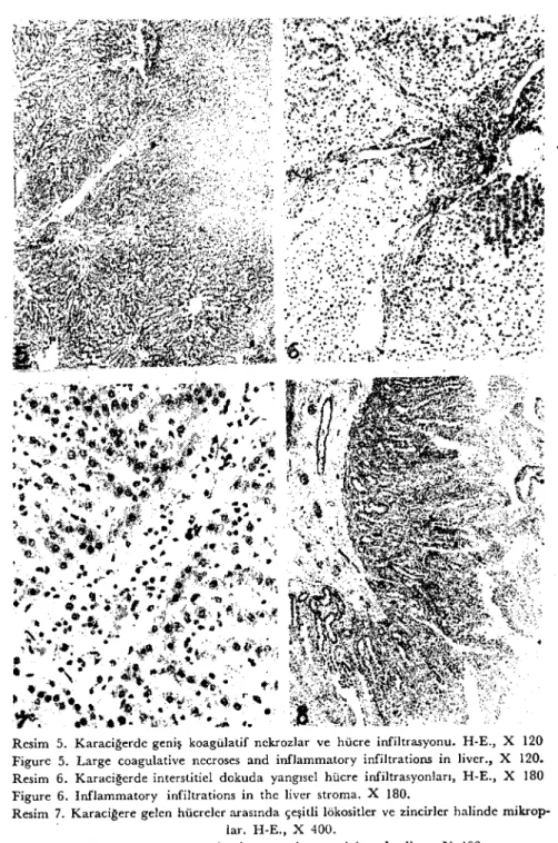 Figure 5. Large coagulative necroses and inflammatory infiltratiOl1S in liver., X 120.