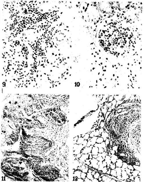Figure 9. Subacute glomerulonephrilis. ~ 400.