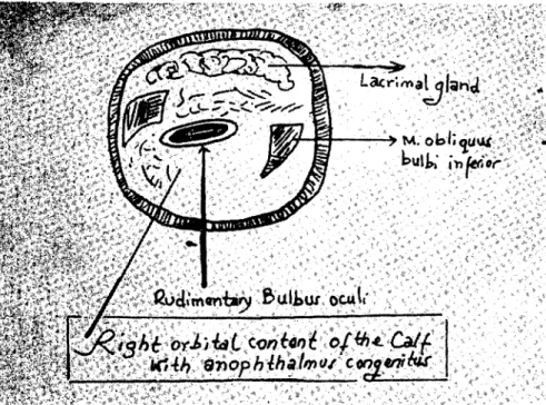Fig. 6. The orbital content of the defected right eye is shown.