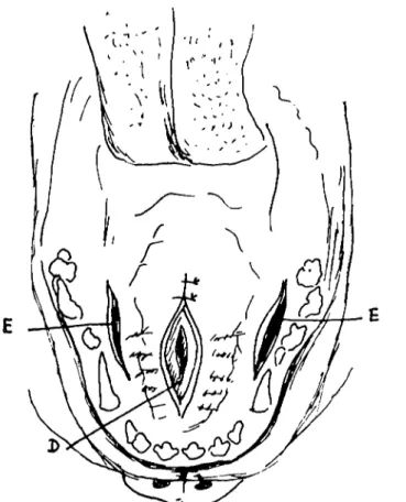 Şekil i oDamak yarığı olayında uygulanan staphylorraphie yöntemi. D) Damak yarığı, E) Damakıa iki yanda yapılan ensizyonlar.