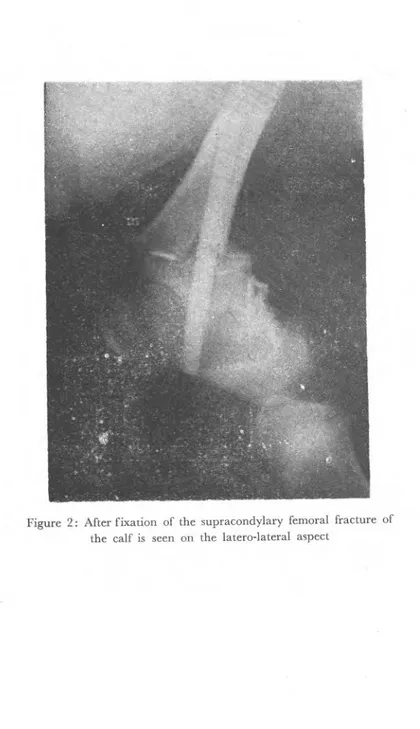 Figure 2: After fixation of the supracondylary femoral fracture of  the calf is seen on the latero-lateral aspect 