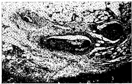 Şekil 2. Submukozadaki damarlarda tromboz. H.E. LO X Fig 2. Trombosis in the submueosal vessels.