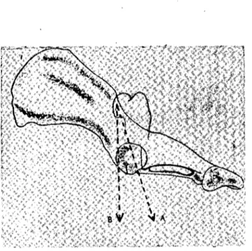 Şekil 4:- Reduction için Os femoris'e verilecek çekiş yönleri. Fig. 4. Reduction of a dorsal anterior dislocation of the hip.