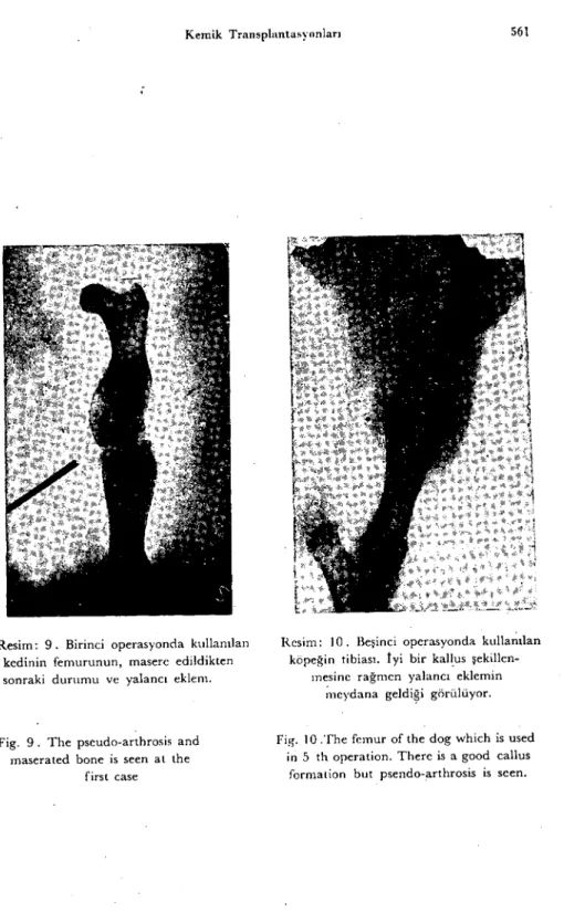 Fig. 9. The pseudo-arthrosis and maserated bone is seen at the
