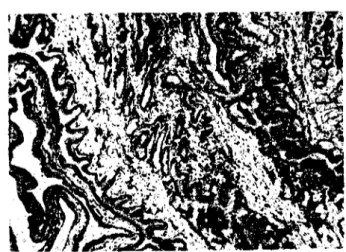 Fig .. 3. Papillary eysıadenoına of the gallbladdee. Adenoma showiııg papillary ar- ar-rangment.