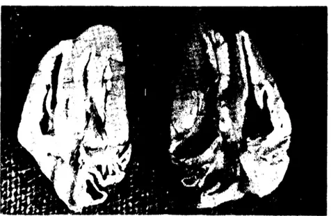 Fig. 5 - Normal and hyalinized myofibrillas intcrmıngled in skeletal muscle.