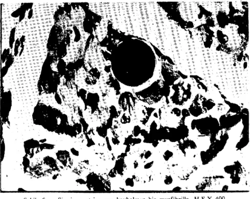 Fig. 7 - Partly hyalinized and segmented myofibrillas in skeletal musele.