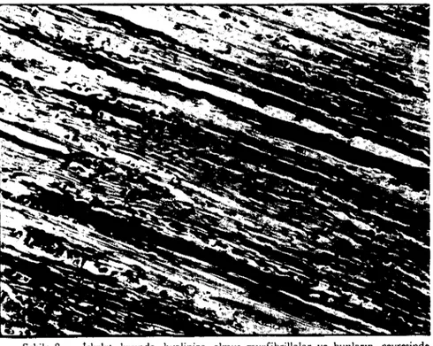 Fig. 8 - Hyalinizcd myofibrillas and cellular infiltration in skcletal muscle.