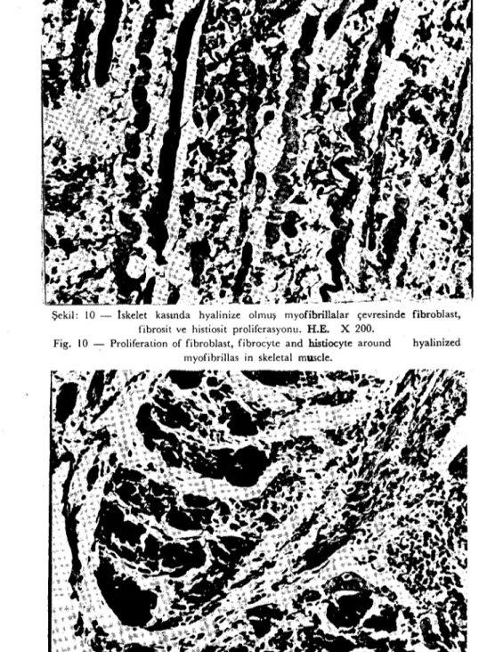 Fig. II - Hyalinized and calcified muscle fibers; and vacuolisation and calcification in Purkinje's fibers İn the heart muscle.