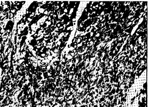 Fig. ız - Hyaline dcgcncration and calcification of myofibrillas in heart muscle.