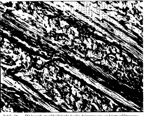 Fig. 14 - Hyaline degeration and cellular infiltratİon ın the mıısdcs of the tongue.