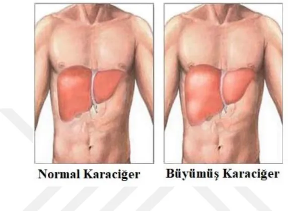 Şekil 3.5. Normal ve büyümüş karaciğer görünümü 