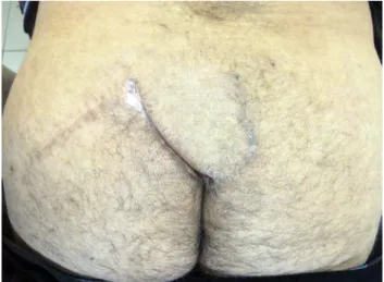 Fig. 2. Postoperative first year image shows well healed gluteal  transposition flap.