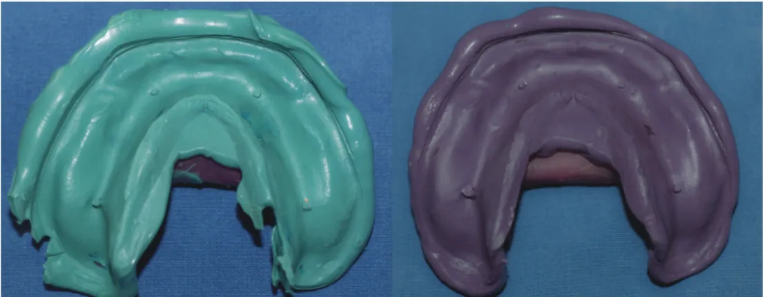 Fig. 3  Impressions of polyether and vinyl polyether siloxane.