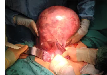 Figure 1. Size comparison Figure 2. Uterus detorsioned for hysterectomy